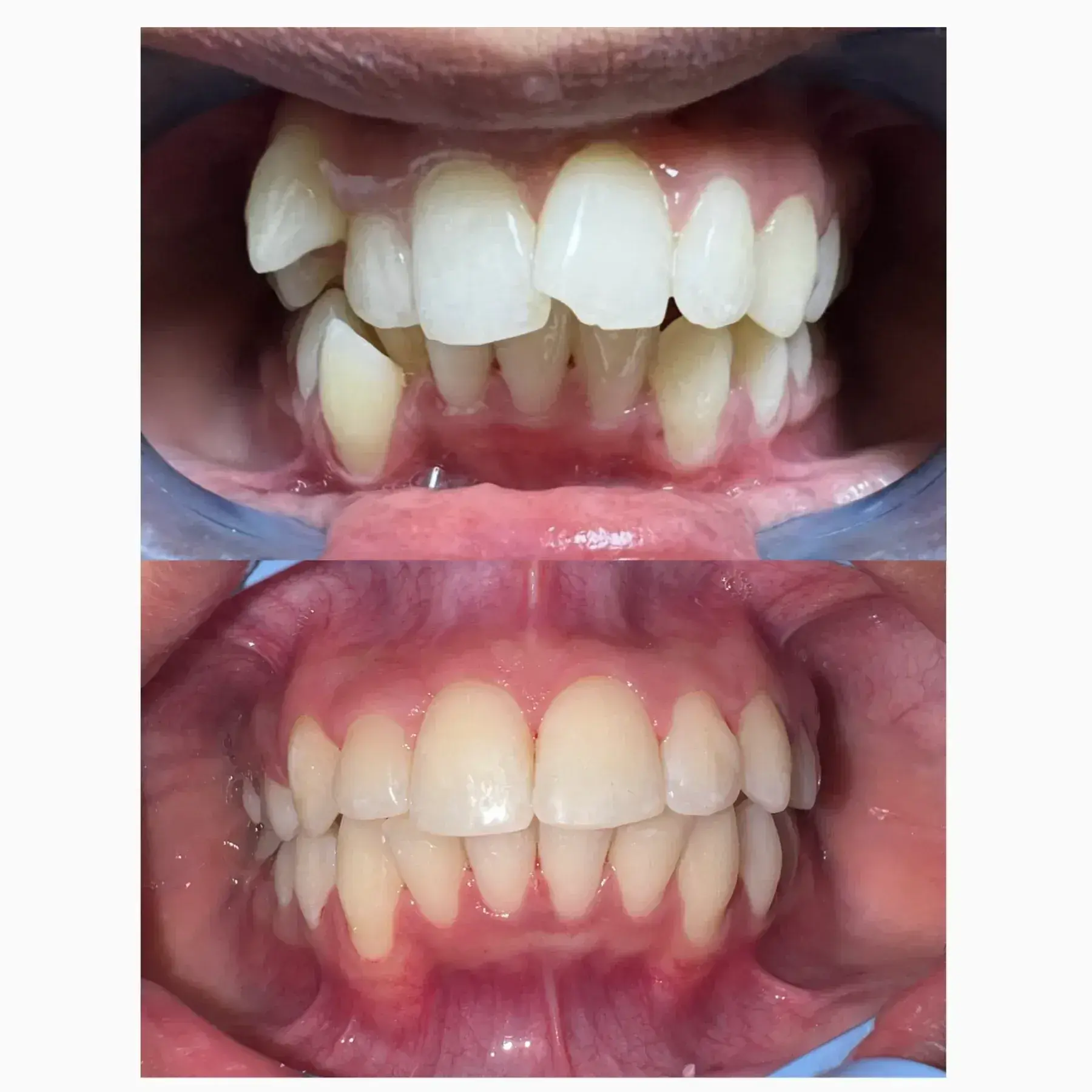 Braces/Orthodontic Treatment — before