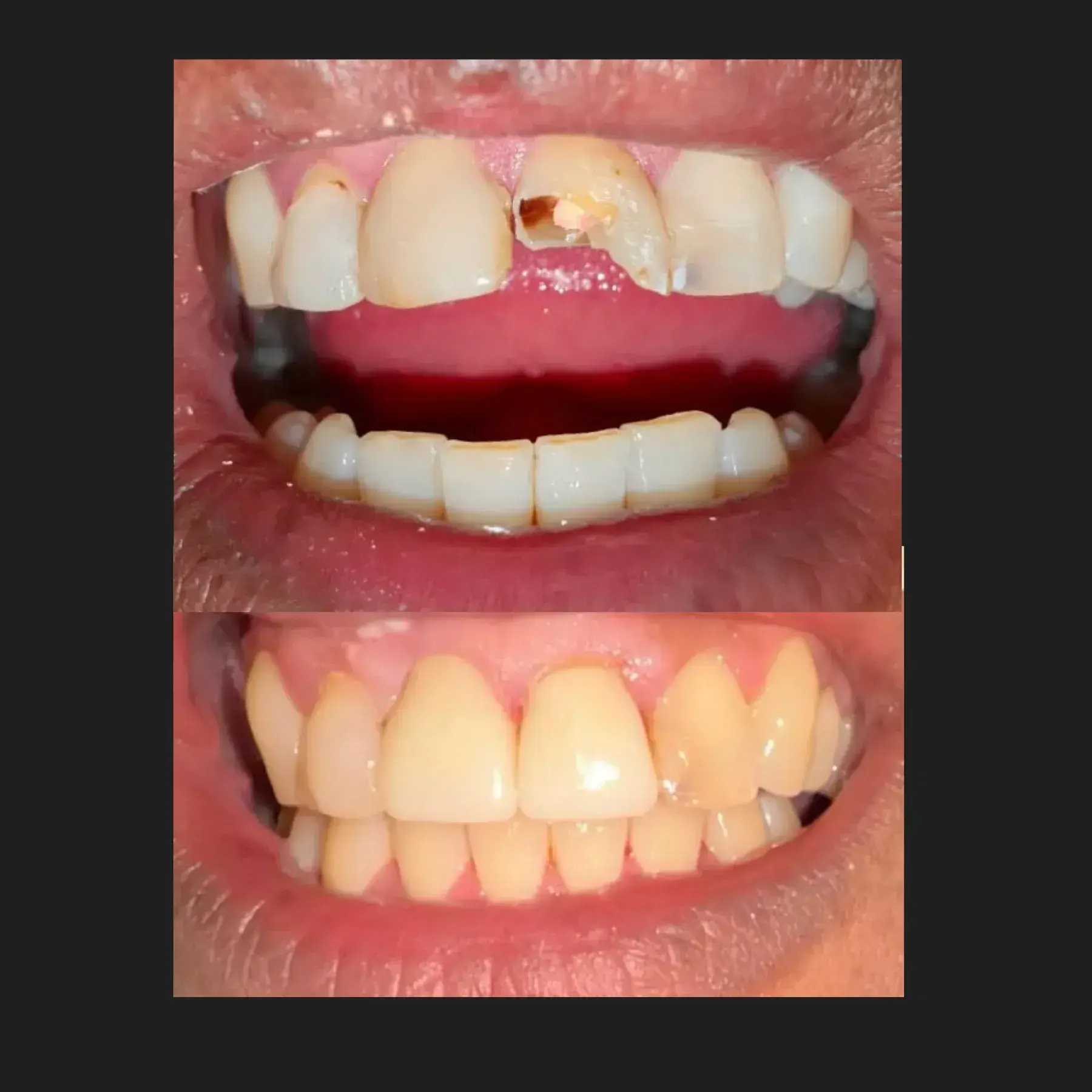 Restorative Care — before