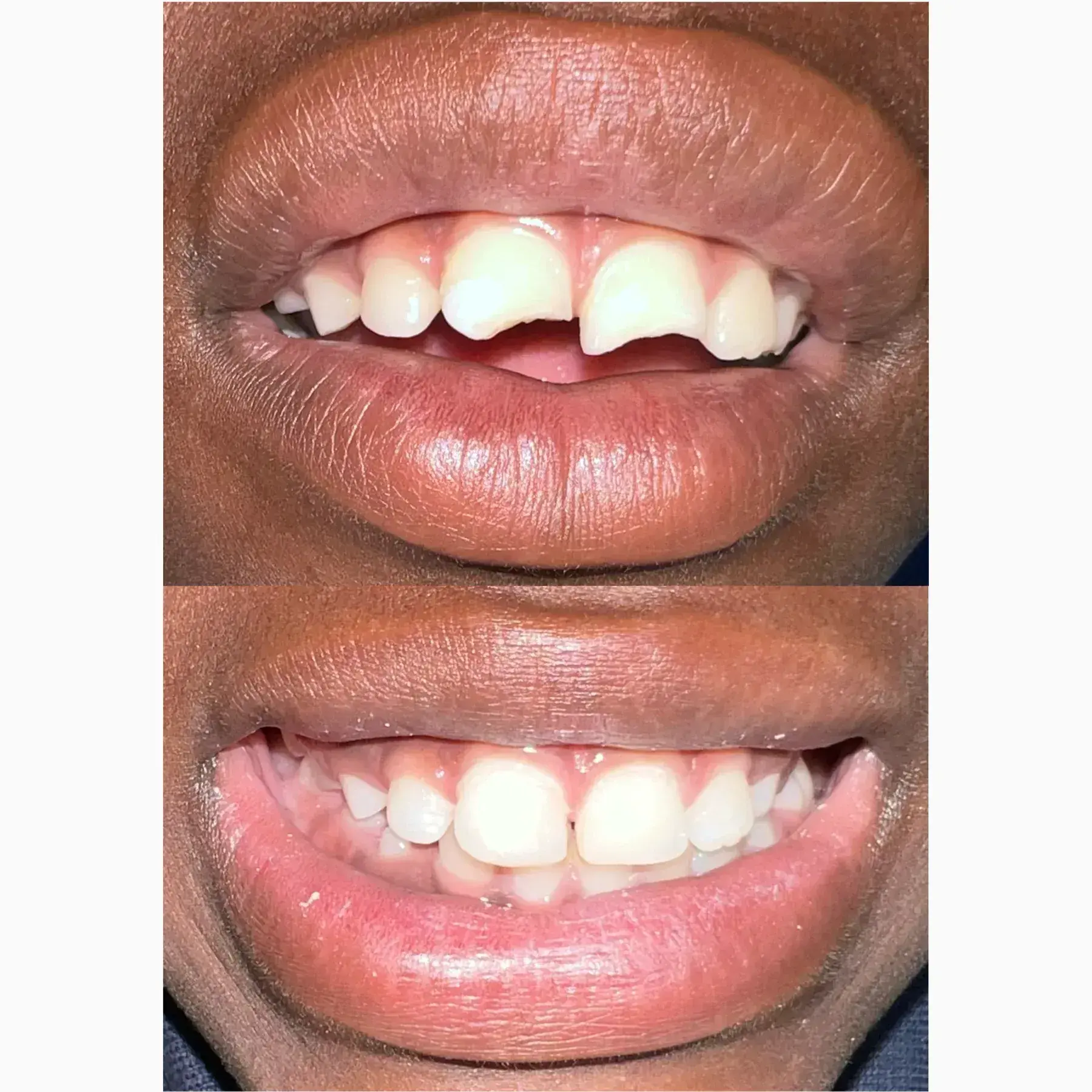 Smile Restoration — before
